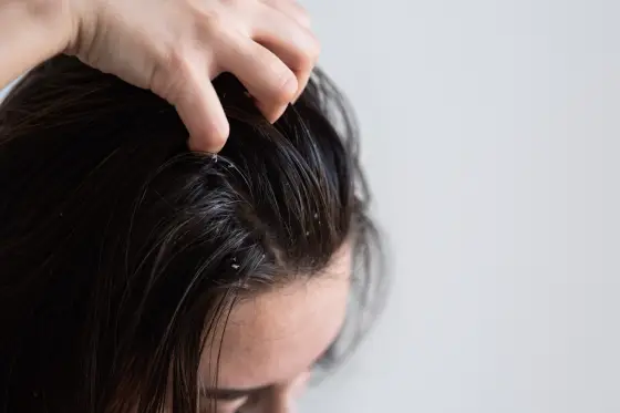Causes and Prevention of Dandruff and Itchy Scalp