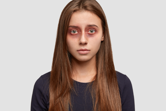 Dark Circles: Causes and Prevention