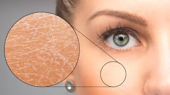 Dehydrated Skin: Know Its Symptoms, Causes, and Prevention