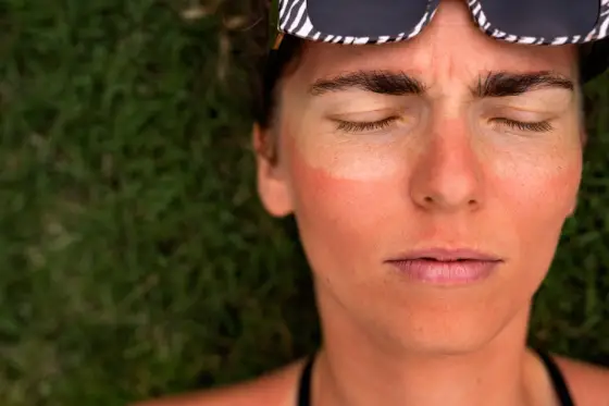 The Do's and Don'ts after the Sun Exposure You Should Know