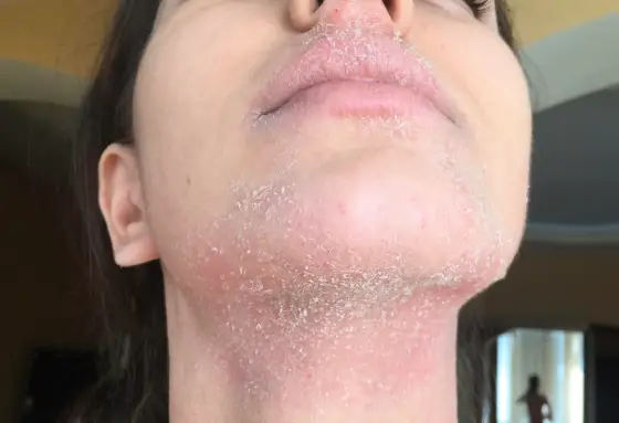Ways to Get Rid of Dry Skin You Didn't Know